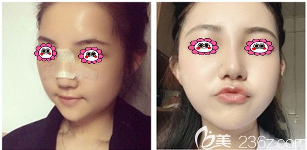 肋軟骨隆鼻7-10天對比照 肋軟骨隆鼻7-10天對比照