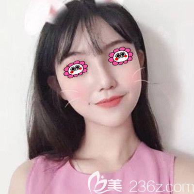 肋軟骨隆鼻一個月正面效果 肋軟骨隆鼻一個月正面效果