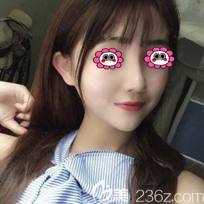 肋軟骨隆鼻2個月后效果圖 肋軟骨隆鼻2個月后效果圖