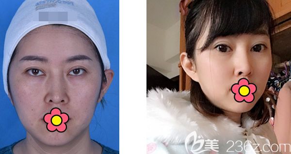 呼市五洲<!--<i data=20240703-sp></i>-->全臉脂肪填充效果怎么樣 呼市五洲<!--<i data=20240703-sp></i>-->全臉脂肪填充效果怎么樣