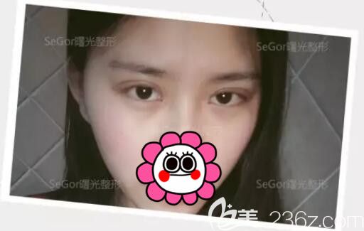 術(shù)后三天韓式雙眼皮腫脹已經(jīng)消退 術(shù)后三天韓式雙眼皮腫脹已經(jīng)消退