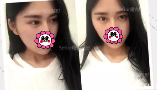 韓式切開雙眼皮的真實(shí)過程及恢復(fù)體驗(yàn)：期待一下常州曙光田文清醫(yī)生0.1mm切口的術(shù)后效果