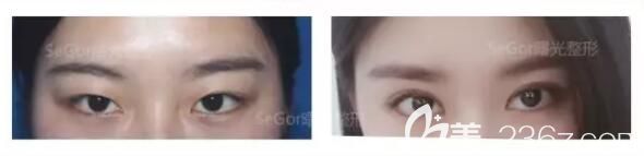 到常州曙光做韓式雙眼皮術(shù)前術(shù)后對比 到常州曙光做韓式雙眼皮術(shù)前術(shù)后對比