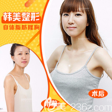 濟(jì)寧韓美自體脂肪隆胸