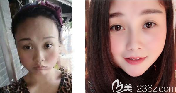 五洲整形<!--<i data=20240703-sp></i>-->面部脂肪填充效果好不好 五洲整形<!--<i data=20240703-sp></i>-->面部脂肪填充效果好不好