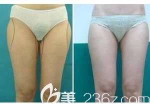 蘇亞美聯(lián)臣整形醫(yī)院做大腿吸脂案例 蘇亞美聯(lián)臣整形醫(yī)院做大腿吸脂案例