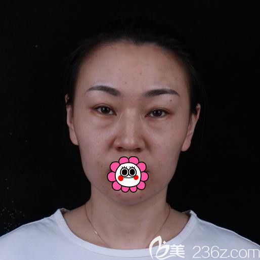 眼綜合術(shù)前重眼袋單鳳眼很顯老 眼綜合術(shù)前重眼袋單鳳眼很顯老