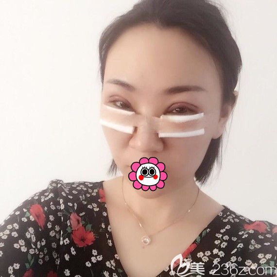 黑龍江瑞麗術(shù)后即刻 黑龍江瑞麗術(shù)后即刻