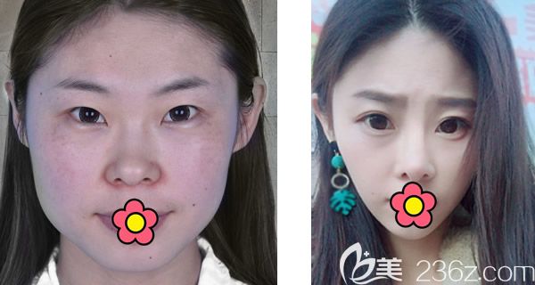 呼市五洲王煥假體隆鼻+面部脂肪填充+激光祛斑案例 呼市五洲王煥假體隆鼻+面部脂肪填充+激光祛斑案例