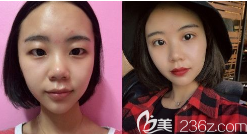 雙眼皮前后對(duì)比 雙眼皮前后對(duì)比