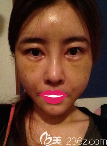 我在韓國S-ONE整形外科做面部脂肪填充+眼鼻整形+豐下巴后1周 我在韓國S-ONE整形外科做面部脂肪填充+眼鼻整形+豐下巴后1周