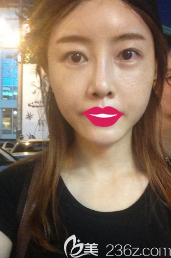 我在韓國S-ONE整形外科做面部脂肪填充+眼鼻整形+豐下巴后1個(gè)月 我在韓國S-ONE整形外科做面部脂肪填充+眼鼻整形+豐下巴后1個(gè)月