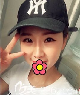 ?線雕隆鼻一個(gè)月后鼻頭露線頭怎么辦 找呼和浩特五洲整形王煥醫(yī)生做鼻整形失敗修復(fù)吧