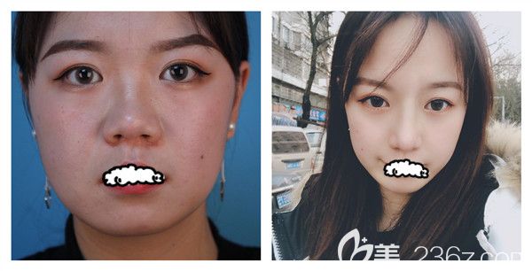 武漢<!--<i data=20240709-sp></i>-->曾寧博士自體軟骨鼻綜合術(shù)后對比案例展示