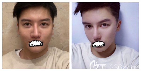 假體隆鼻失敗歪鼻梁術(shù)后修復(fù)，曾寧主任膨體鼻綜合術(shù)后對比效果照