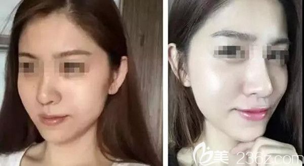 DNA童顏針換膚逆齡前后效果圖