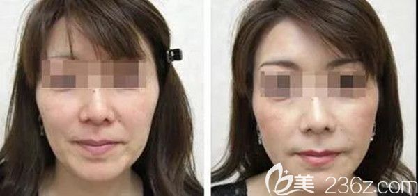 DNA童顏針注射前后對(duì)比圖