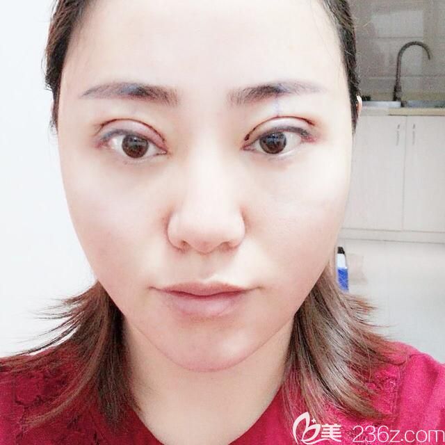 讓胡準做埋線提升+眼綜合+玻尿酸填充淚溝第3天