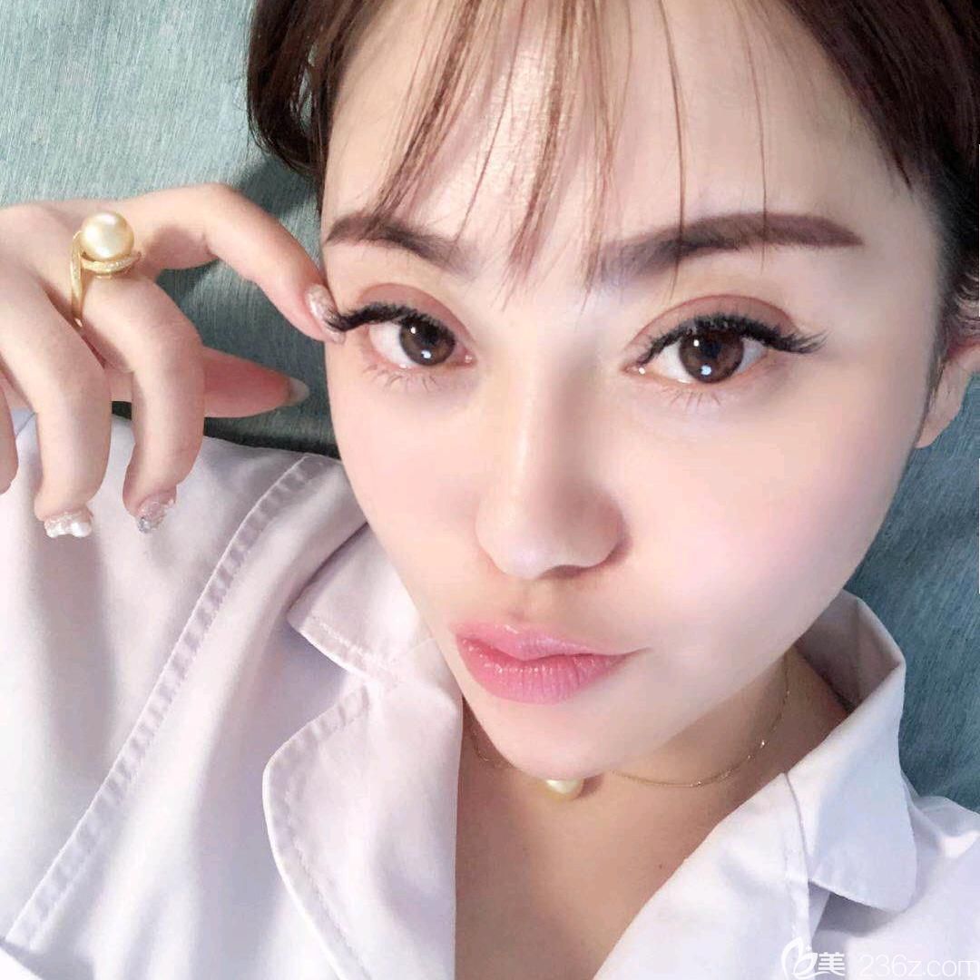 讓合肥白領安琪兒胡準做了全臉埋線提升+眼綜合+注射玻尿酸填充淚溝，一個月后我竟然變成了這個樣子……