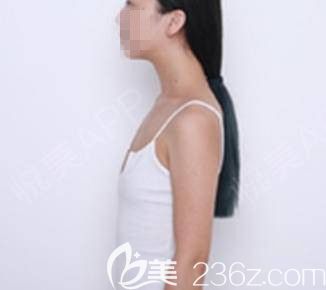 洛陽華美假體豐胸前 洛陽華美假體豐胸前