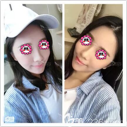 做假體墊下巴術(shù)后一周拆線 做假體墊下巴術(shù)后一周拆線