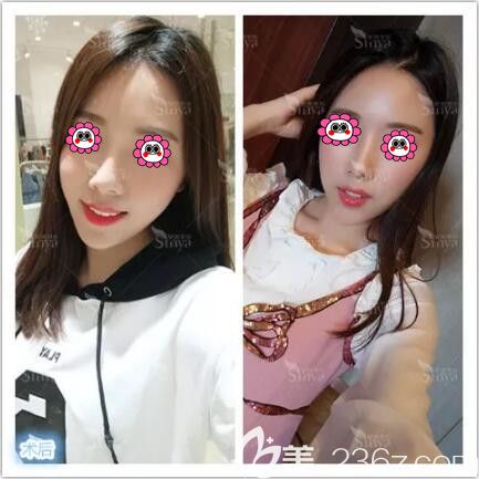 在長(zhǎng)沙做假體墊下巴一個(gè)月效果 在長(zhǎng)沙做假體墊下巴一個(gè)月效果