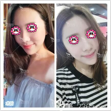 在長(zhǎng)沙星雅做假體豐下巴一個(gè)半月恢復(fù)效果 在長(zhǎng)沙星雅做假體豐下巴一個(gè)半月恢復(fù)效果