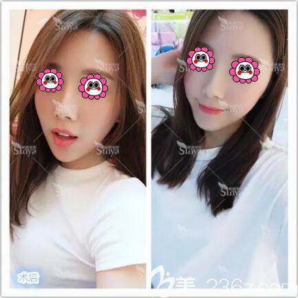 真人案例：沒想到下巴短小的我在長沙星雅整形醫(yī)院做了假體墊下巴后 成功晉升為小仙女！