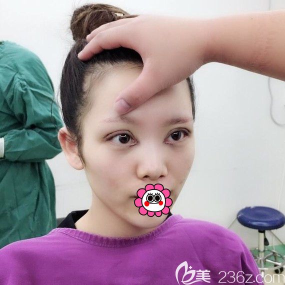 黑龍江瑞麗雙眼皮修復(fù)術(shù)后即刻