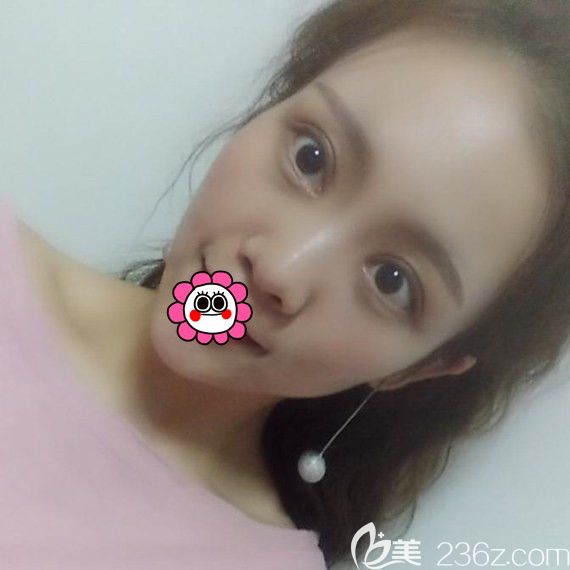 黑龍江瑞麗雙眼皮修復(fù)效果怎么樣？