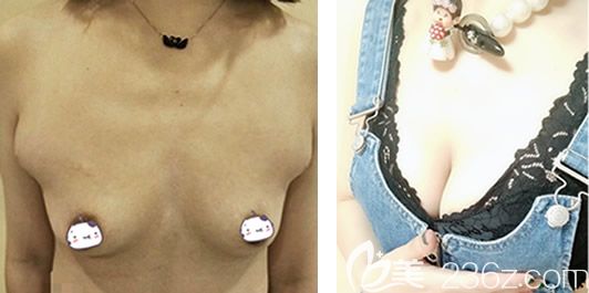 看完呼和浩特五洲整形王煥院長(zhǎng)假體隆胸、副乳切除和乳房下垂矯正案例 你的心情怎么樣