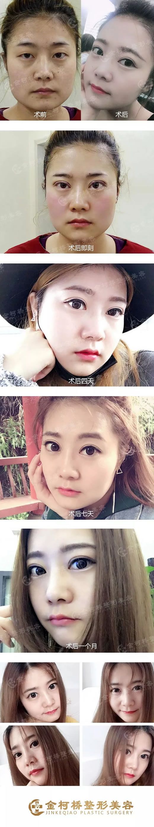 <!--<i data=20240703-sp></i>--><!--<i data=20240703-sp></i>-->林建華雙眼皮案例