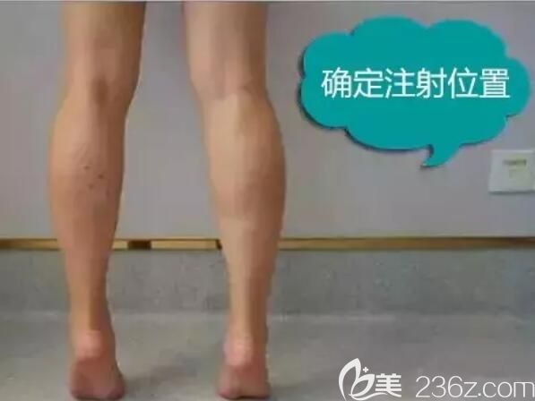 術(shù)前墊腳確定注射瘦臉除皺位置