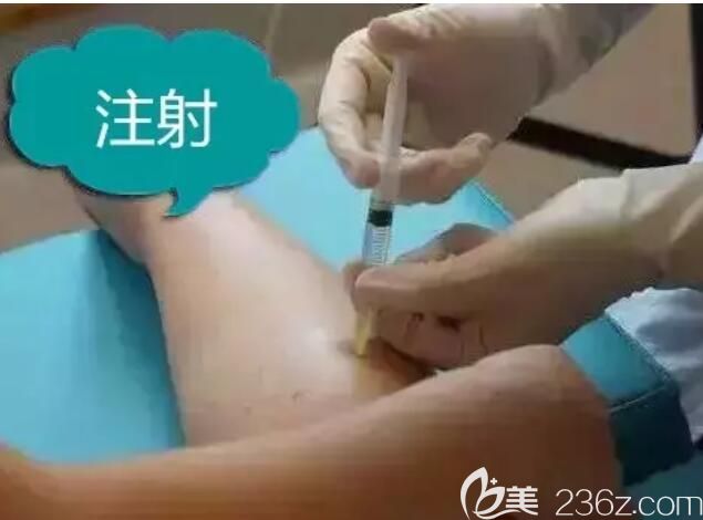 無錫愛思特醫(yī)生注射瘦腿操作中