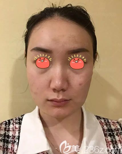 紹興維美整形做面部線雕手術(shù)前 紹興維美整形做面部線雕手術(shù)前