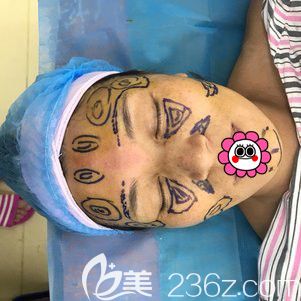 自體脂肪填充面部術中畫線