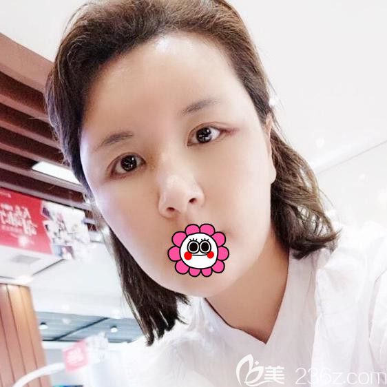 自體脂肪面部填充后10天臉還是有點腫