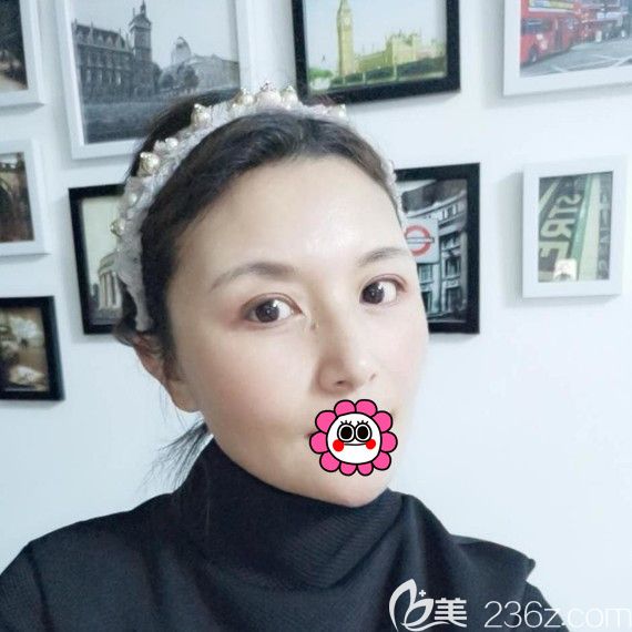 在黑龍江瑞麗了解自體脂肪面部填充一月效果很好，不知道能維持多久