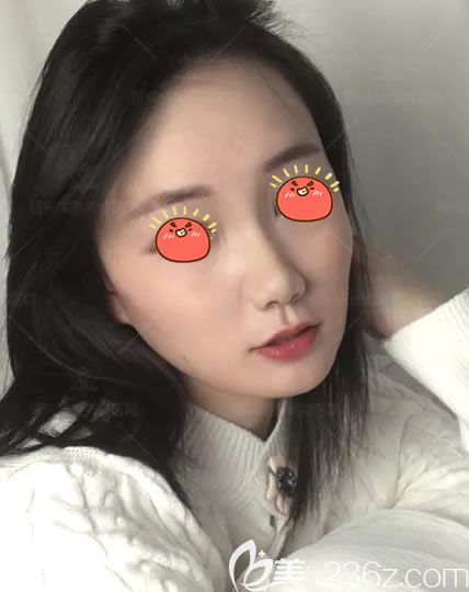 種草很久的埋線提升手術(shù),終于在紹興維美整形李俊霞這兒做了全面部線雕,現(xiàn)分享我的線雕日記