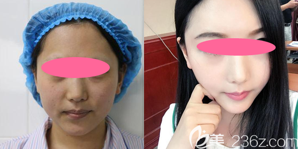 匯總一份上饒尚美張維華劉育鳳等醫(yī)生隆鼻自體脂肪填充整形效果圖給大家參考