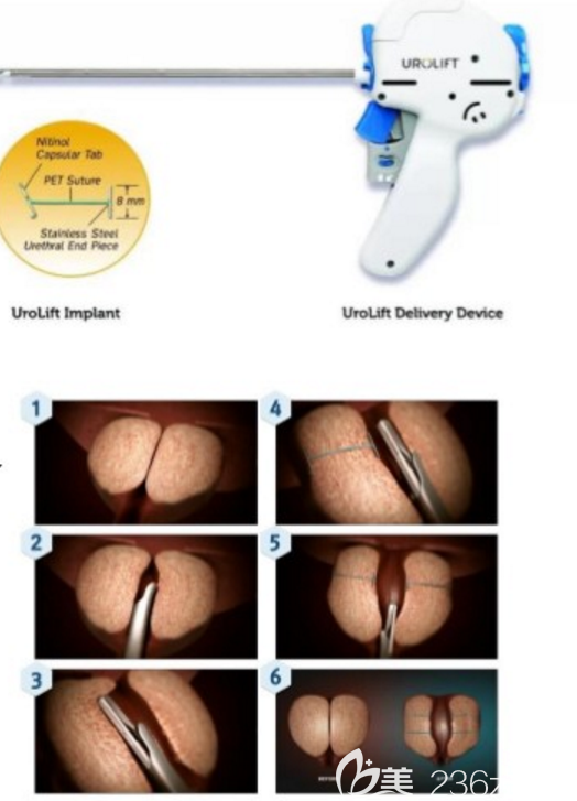 前列腺肥大Urolift微創(chuàng)手術(shù) 前列腺肥大Urolift微創(chuàng)手術(shù)