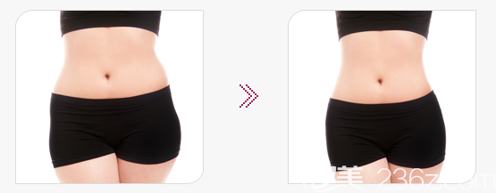 韓國(guó)光明整形外科吸脂手術(shù)案例