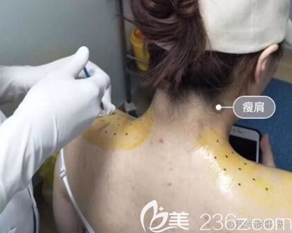 郴州曹家整形真人注射瘦肩過(guò)程