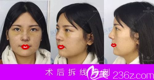 盧闖醫(yī)生為我做肋軟骨隆鼻術(shù)后7天進(jìn)行拆線