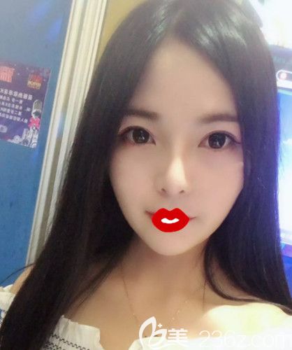 在石家莊藍(lán)山做肋軟骨隆鼻18天完全消腫