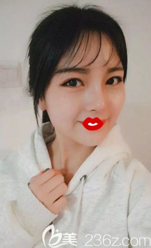 盧闖醫(yī)生為我做肋軟骨隆鼻25天鼻子變立體