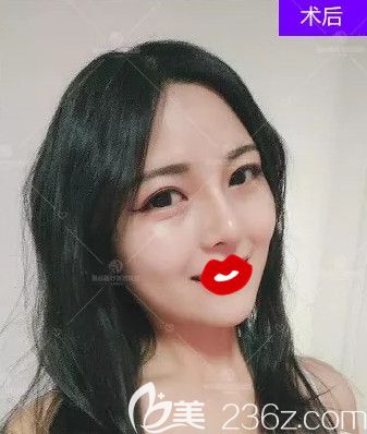 本想做假體隆鼻術(shù)來改善朝天鼻 到石家莊藍(lán)山盧闖醫(yī)生建議我做自體肋軟骨隆鼻術(shù)效果還不錯(cuò)