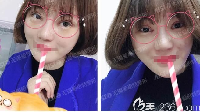 術(shù)后一周雙眼皮拆線恢復(fù)中 術(shù)后一周雙眼皮拆線恢復(fù)中