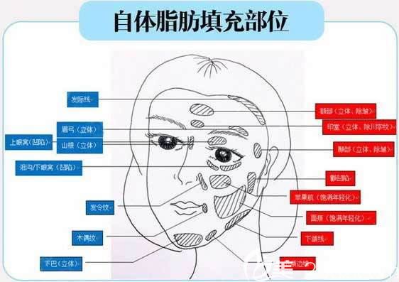 想知道自體脂肪豐太陽(yáng)穴多少錢(qián)的,看這里嘉興曙光公布了脂肪填充類(lèi)手術(shù)價(jià)格啦