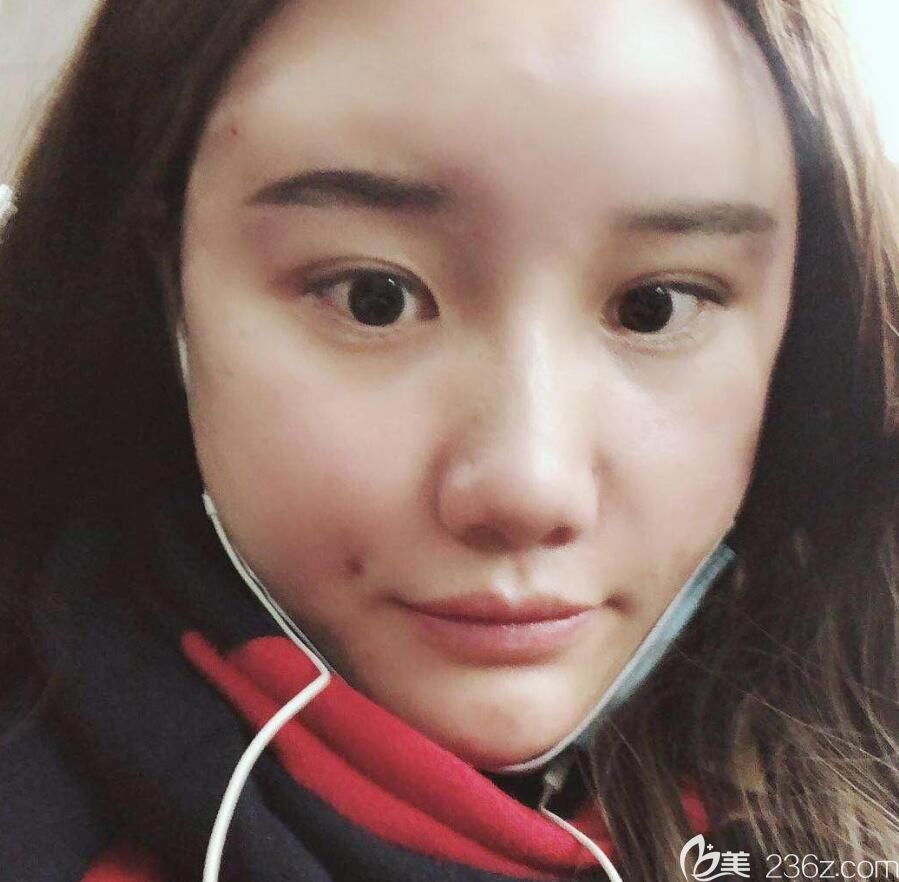 胡準剛做完自體脂肪填充全臉術(shù)后照